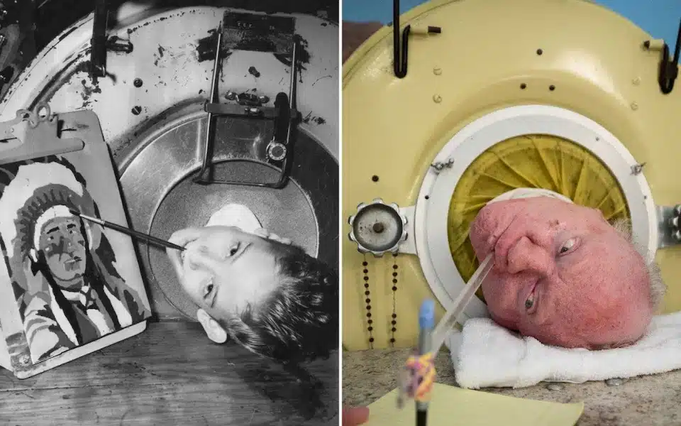 polio Paul Alexander and why vaccines matter